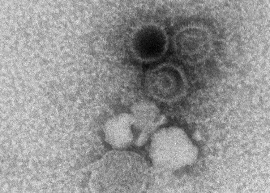 Epstein-Barr virus protein can “switch on” risk genes for autoimmune diseases